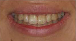 ToothStripsAfter.jpg