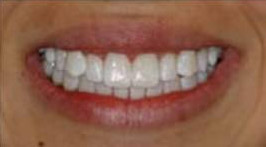 ToothStripsBefore.jpg