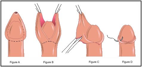 circumcision.jpg