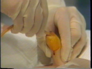 catheter.jpg
