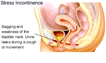 stress_incontinence.gif