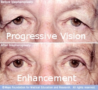 blepharoplasty.jpg